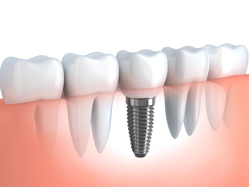 Dental Implants Center, TX