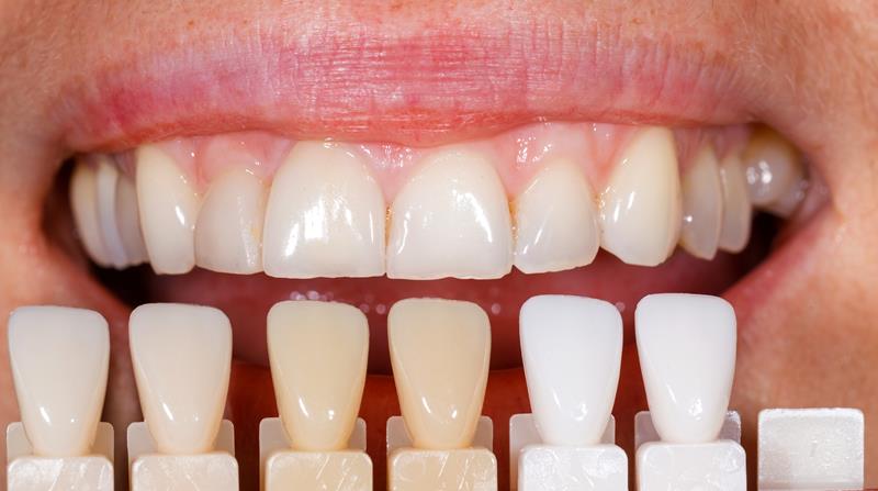 Veneers Center, TX